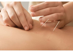 Pain Management Acupuncture in NYC | Back, Neck & Sciatica Relief
