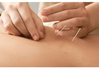 Pain Management Acupuncture in NYC | Back, Neck & Sciatica Relief